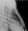 5. Sternomanubrial Dislocation